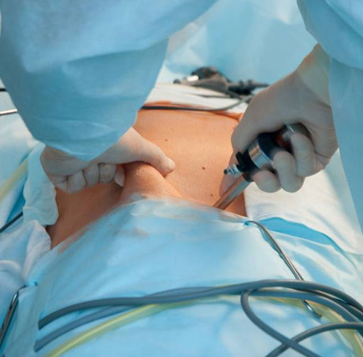 Operacia-zlcnika-laparoskopicky